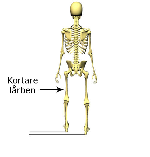 Här är vissas en strukturell benlängdsskillnad där femur (lårbenet) är kortare på vänster sida.