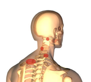 Nackspärr kan sitta på olika nivåer i halsryggen med påverkan av muskler och leder.